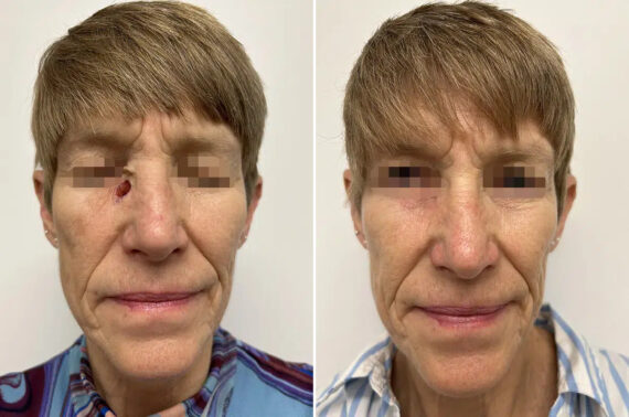 Mohs Reconstruction Before and After Photos in Princeton, NJ, Patient 12144