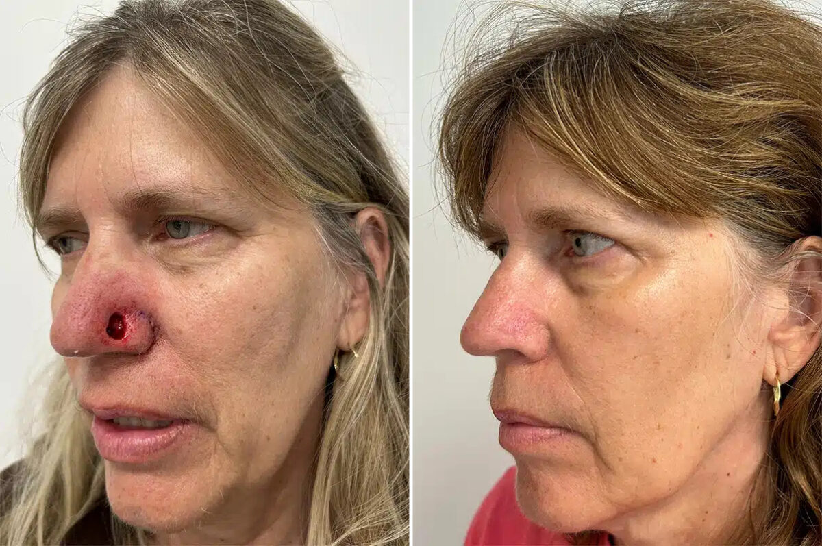 Mohs Reconstruction Before and After Photos in Princeton, NJ, Patient 12151