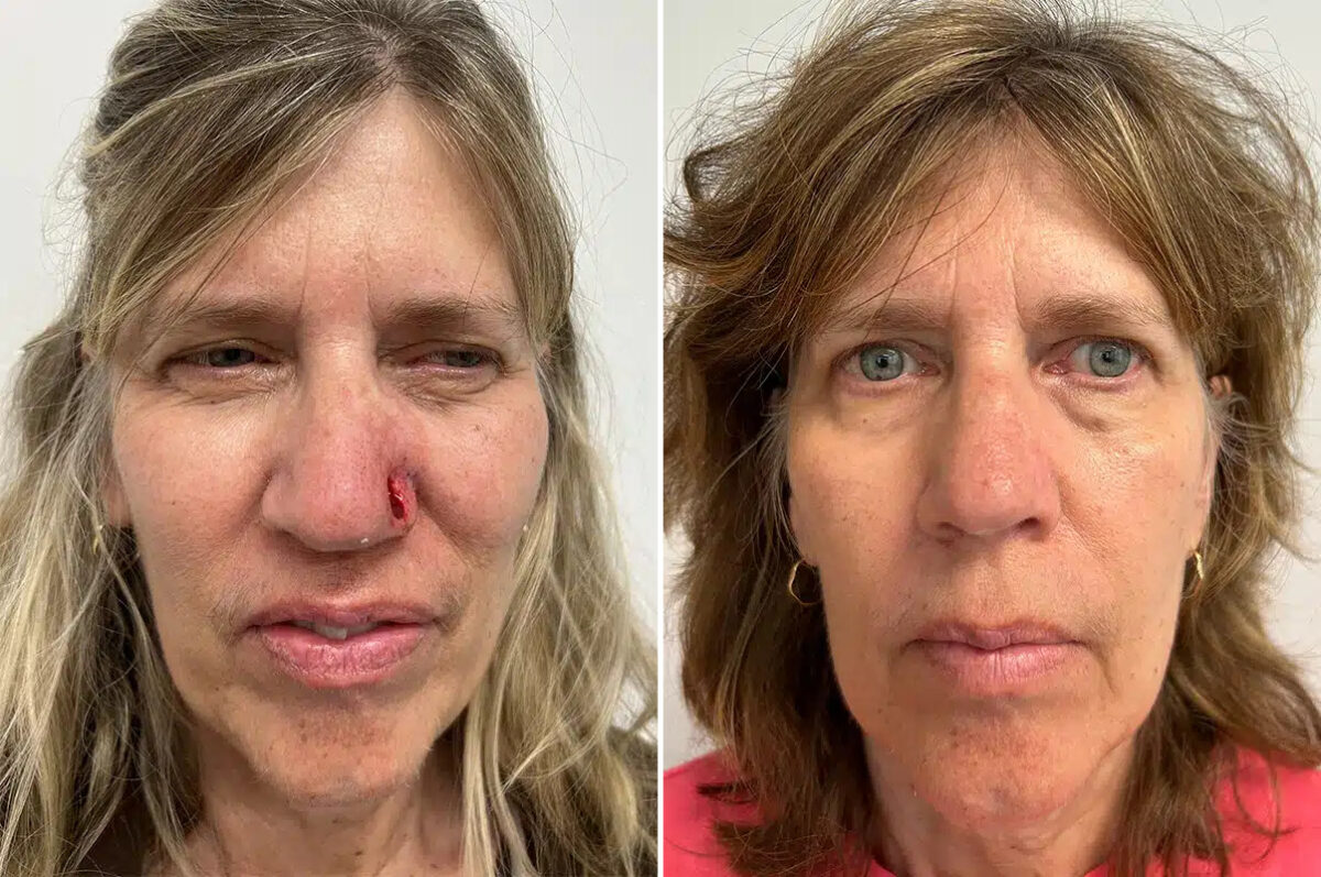 Mohs Reconstruction Before and After Photos in Princeton, NJ, Patient 12151