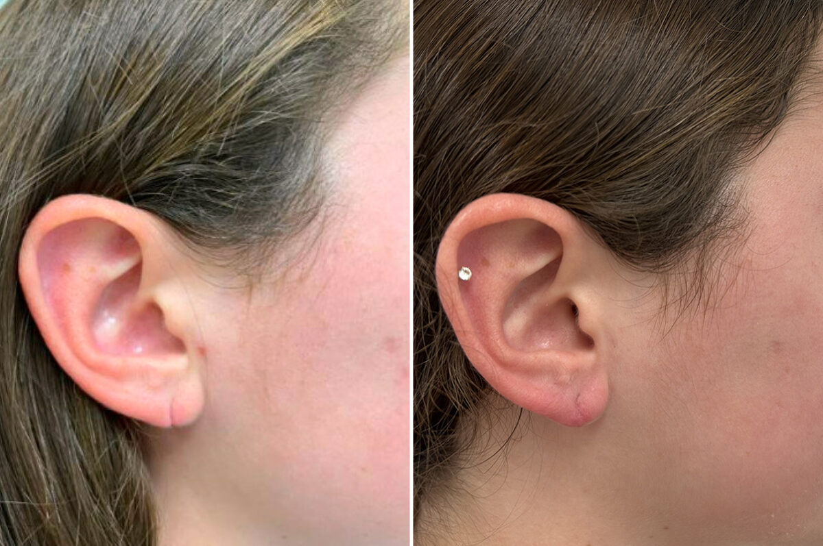 Earlobe Repair Before and After Photos in Princeton, NJ, Patient 12158
