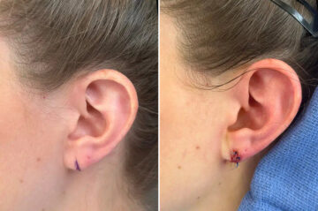 Earlobe Repair Before and After Photos in Princeton, NJ, Patient 12162