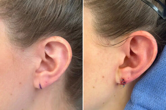 Earlobe Repair Before and After Photos in Princeton, NJ, Patient 12162