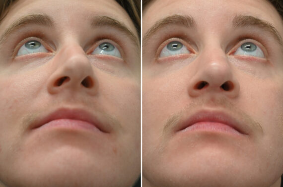 Rhinoplasty Before and After Photos in Princeton, NJ, Patient 12166