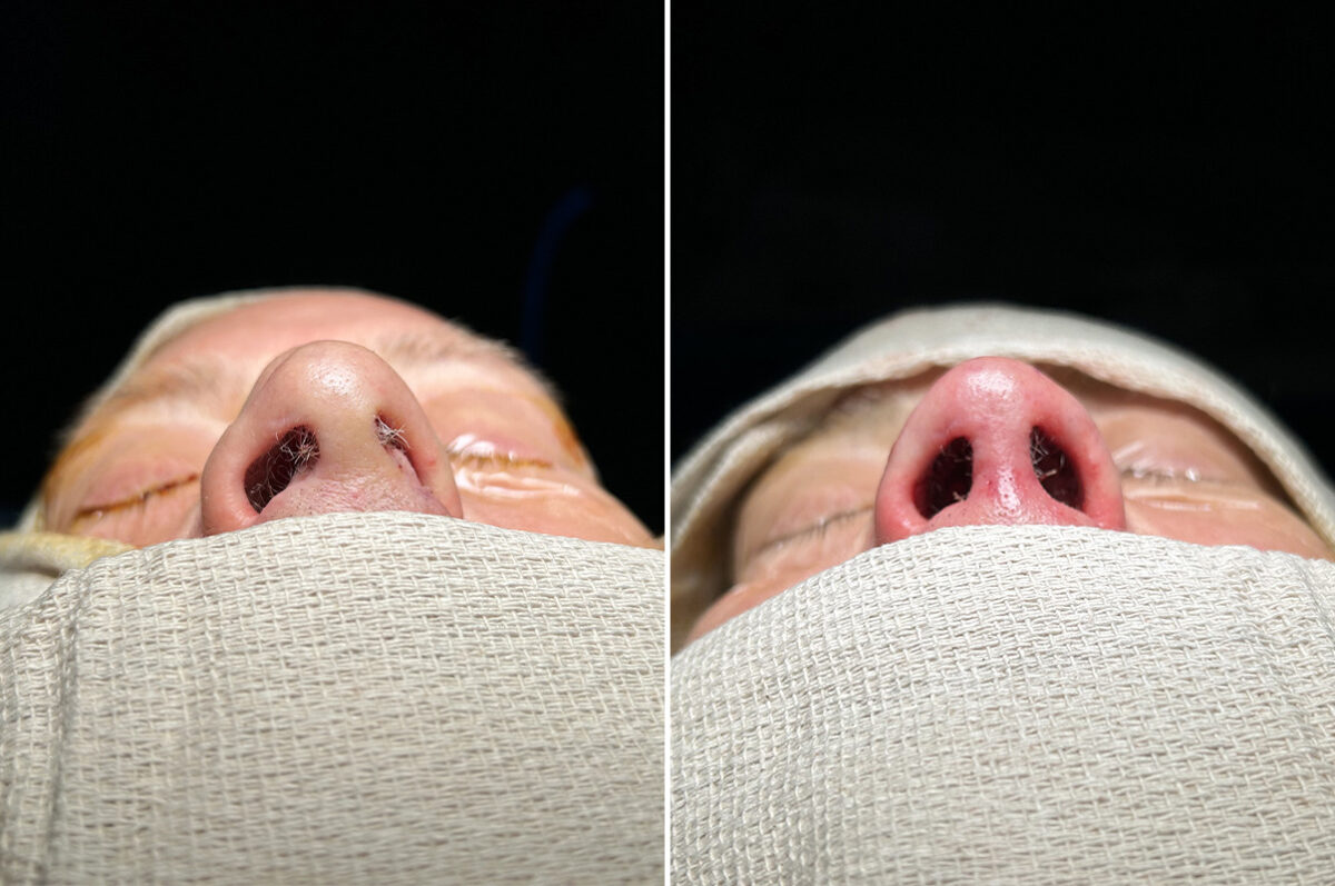 Rhinoplasty Before and After Photos in Princeton, NJ, Patient 12170