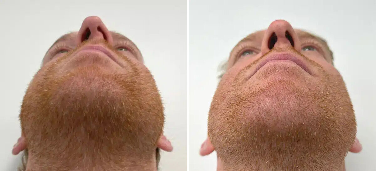 Rhinoplasty Before and After Photos in Princeton, NJ, Patient 12174