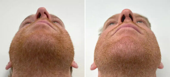 Rhinoplasty Before and After Photos in Princeton, NJ, Patient 12174