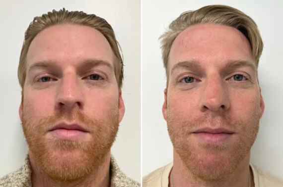 Rhinoplasty Before and After Photos in Princeton, NJ, Patient 12174