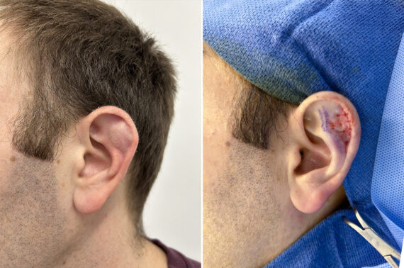 Cyst & Mass Removal Before and After Photos in Princeton, NJ, Patient 12181