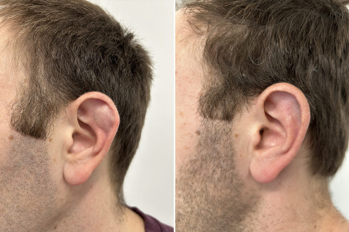 Cyst & Mass Removal Before and After Photos in Princeton, NJ, Patient 12181