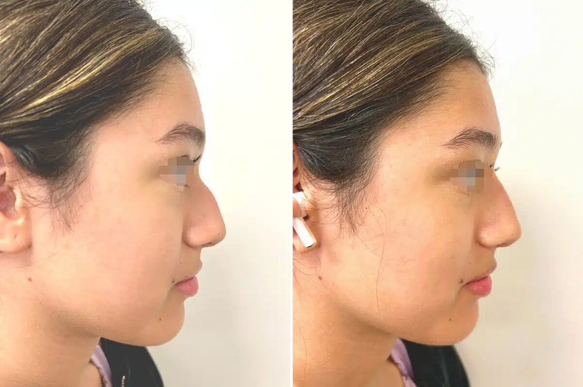 Liquid Rhinoplasty Before and After Photos in Princeton, NJ, Patient 12188