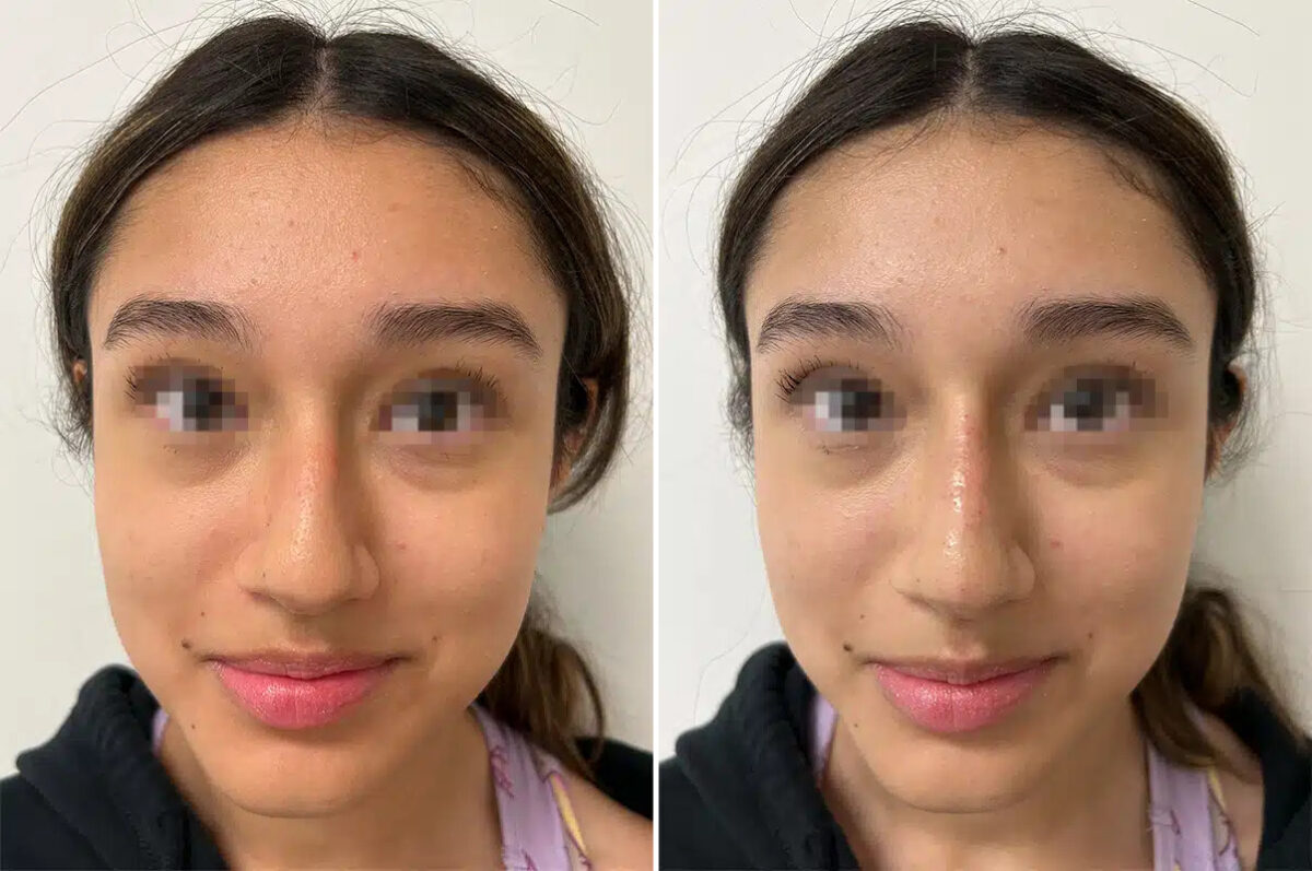 Liquid Rhinoplasty Before and After Photos in Princeton, NJ, Patient 12188