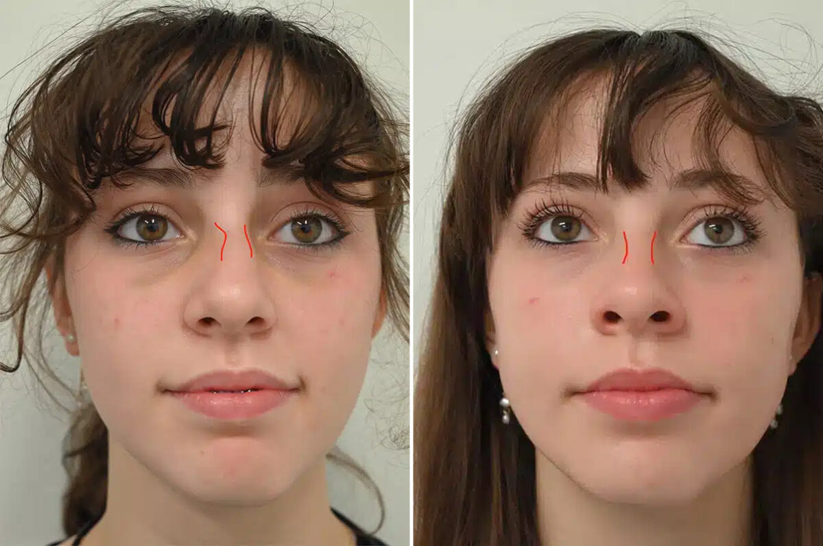 Nasal Trauma Before and After Photos in Princeton, NJ, Patient 12197