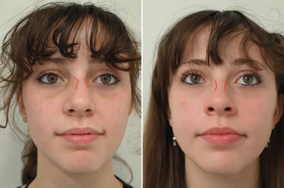 Nasal Trauma Before and After Photos in Princeton, NJ, Patient 12197