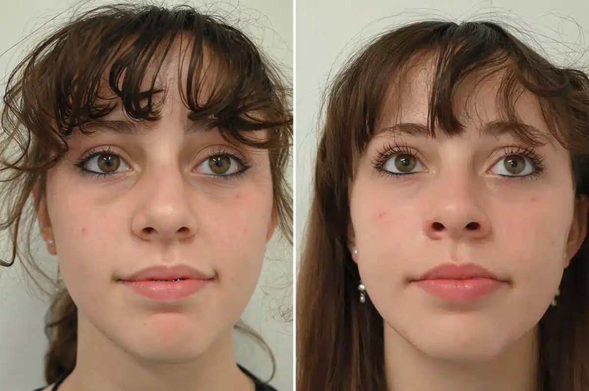 Nasal Trauma Before and After Photos in Princeton, NJ, Patient 12197