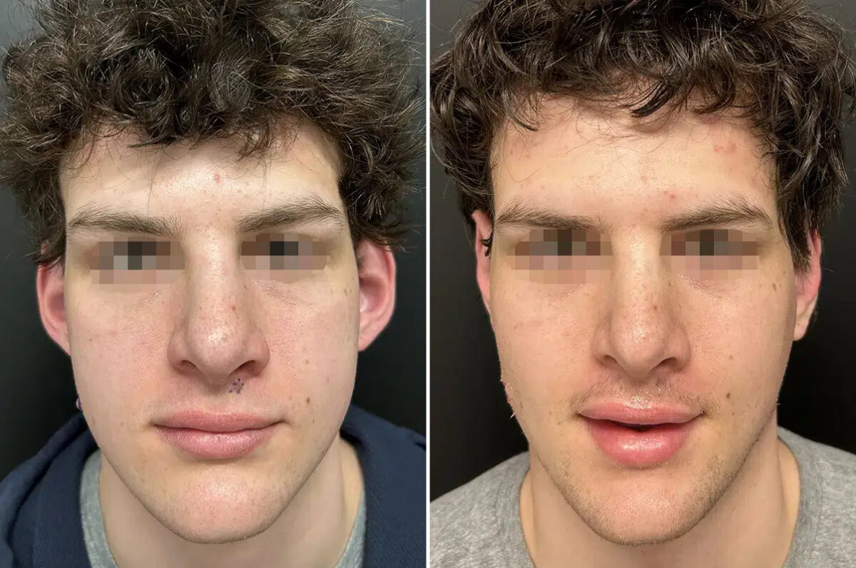 Otoplasty Before and After Photos in Princeton, NJ, Patient 12204