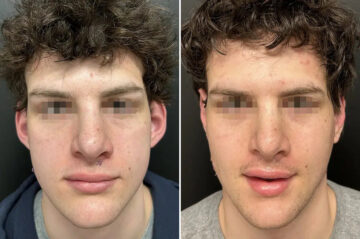 Otoplasty Before and After Photos in Princeton, NJ, Patient 12204