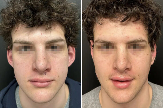 Otoplasty Before and After Photos in Princeton, NJ, Patient 12204