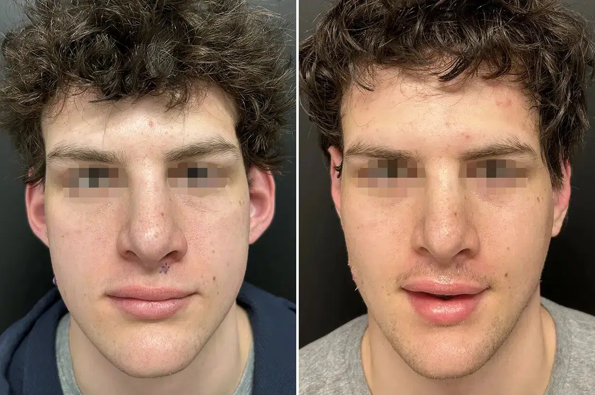 patient-12204-otoplasty-before-after