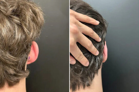 Otoplasty Before and After Photos in Princeton, NJ, Patient 12204