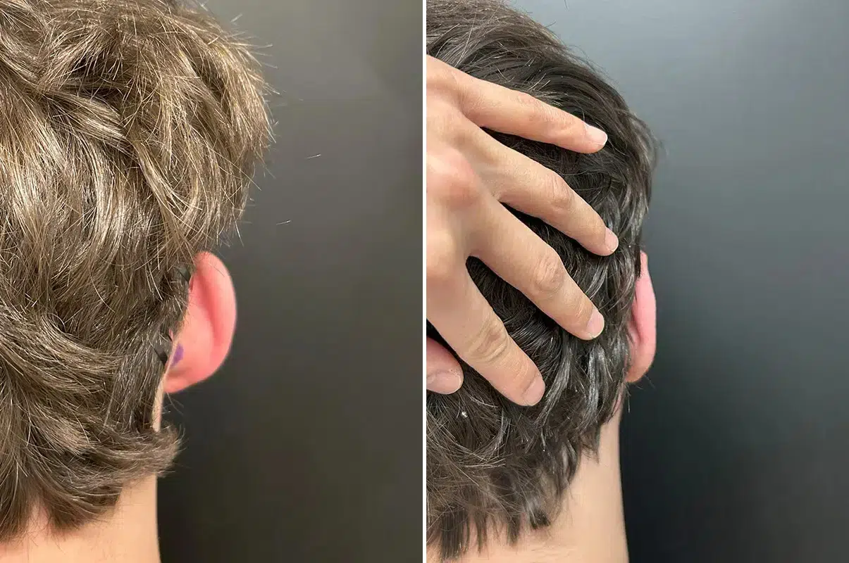 patient-12204-otoplasty-before-after