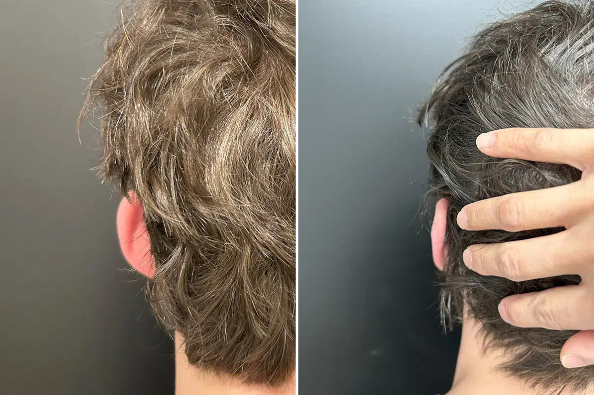 Otoplasty Before and After Photos in Princeton, NJ, Patient 12204