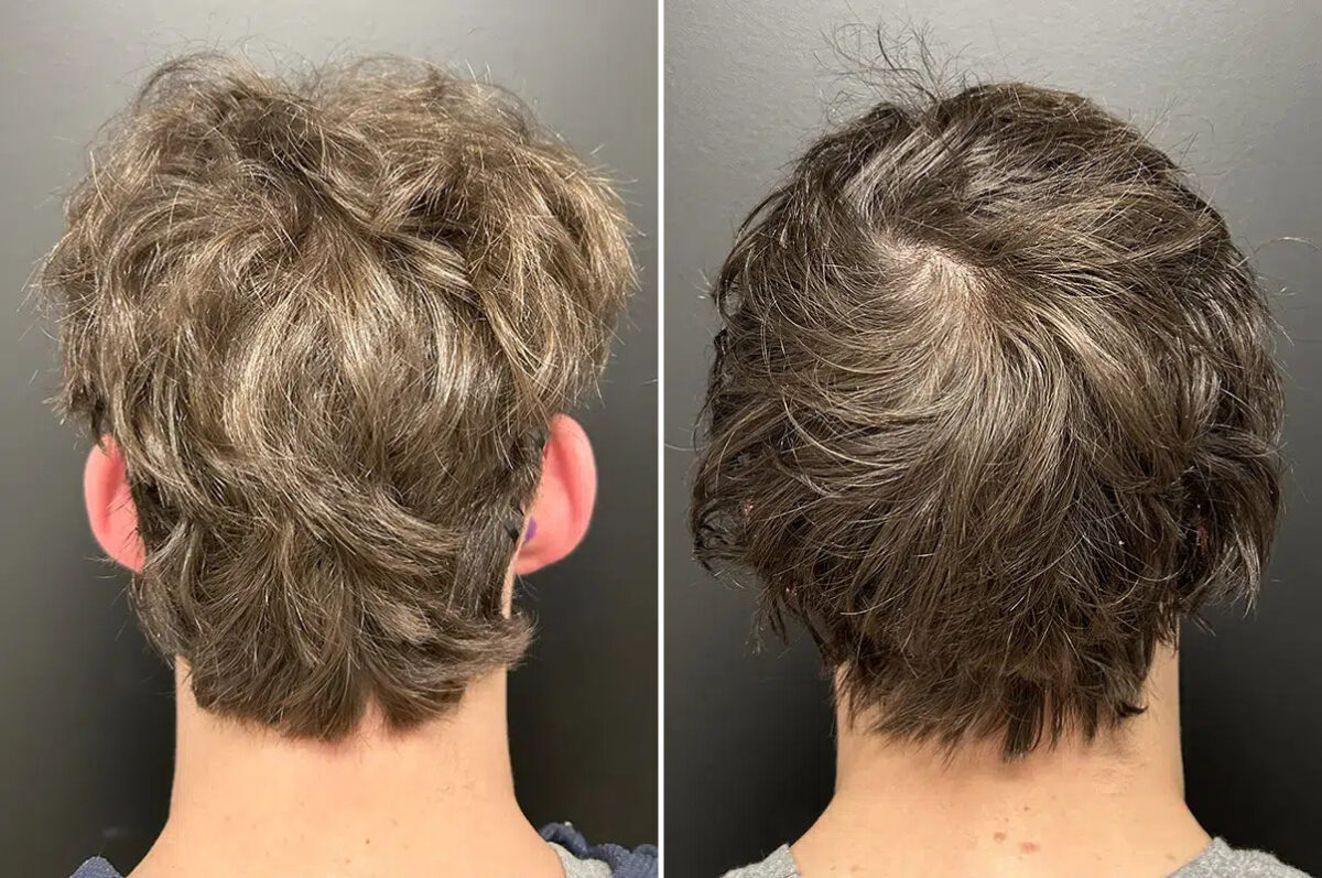 Otoplasty Before and After Photos in Princeton, NJ, Patient 12204