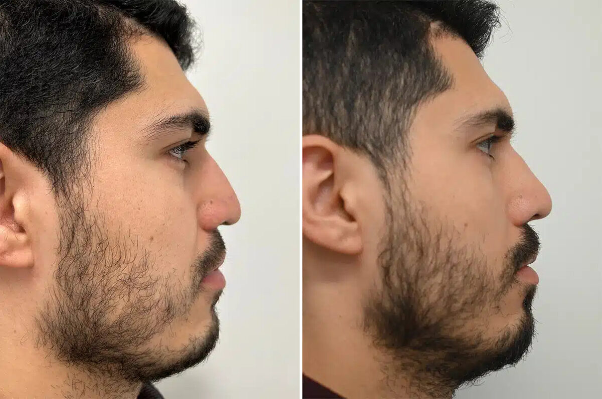 Revision Rhinoplasty Before and After Photos in Princeton, NJ, Patient 12223