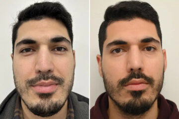 Revision Rhinoplasty Before and After Photos in Princeton, NJ, Patient 12223