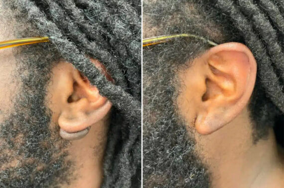 Scar Revision Before and After Photos in Princeton, NJ, Patient 12230