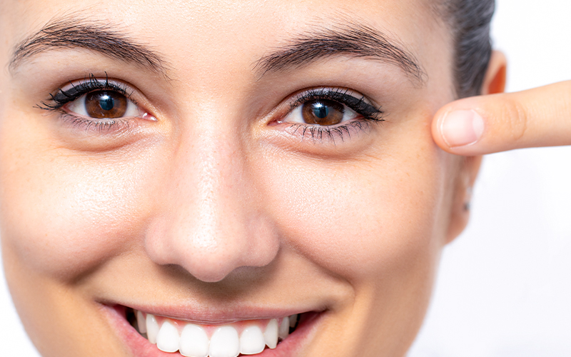 Smiling woman pointing to fine lines at outer eye corner, highlighting crow’s feet area commonly treated with Botox