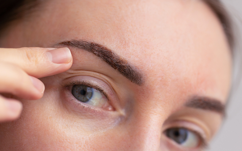 Close-up of glabellar lines between eyebrows, showing common Botox area to reduce frown wrinkles and tension