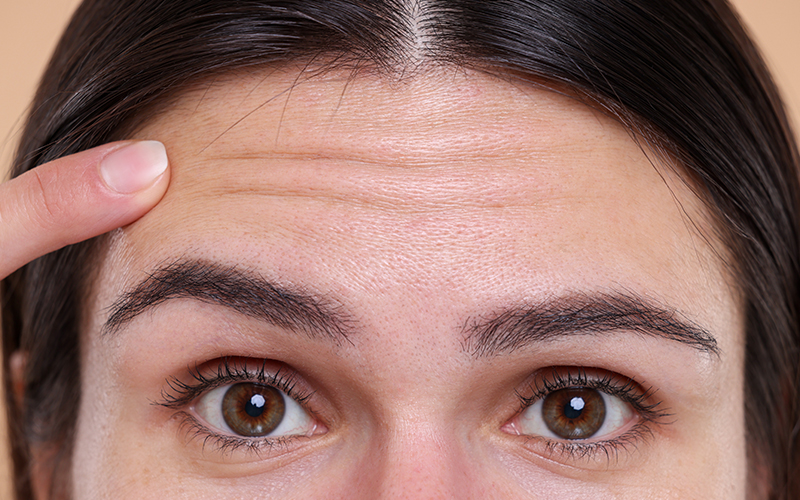 Close-up of woman's forehead with visible horizontal wrinkles, showing common Botox treatment area for wrinkle reduction