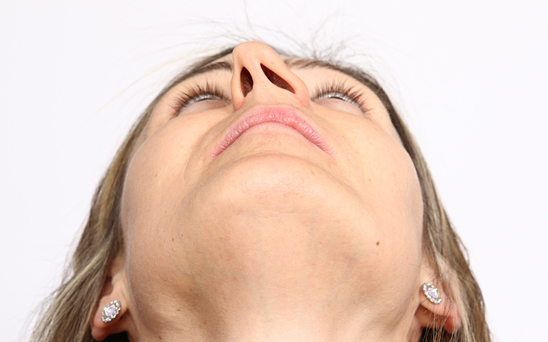 Woman tilting head back showing nasal passages, illustrating a deviated septum before septoplasty treatment.
