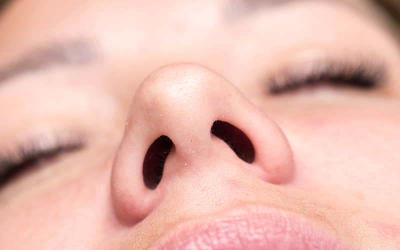 Close-up of nostrils showing internal nasal structures related to turbinate hypertrophy and airway obstruction