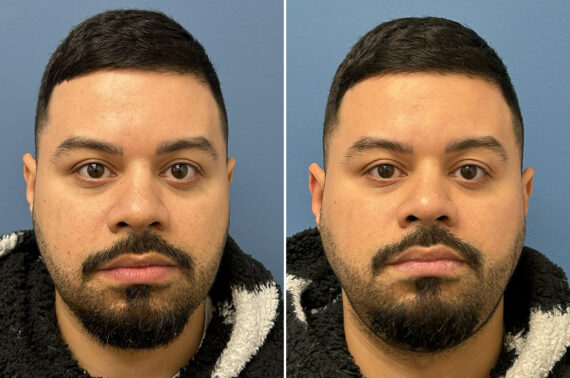 Buccal Fat Removal Before and After Photos in Philadelphia, PA, Patient 12300