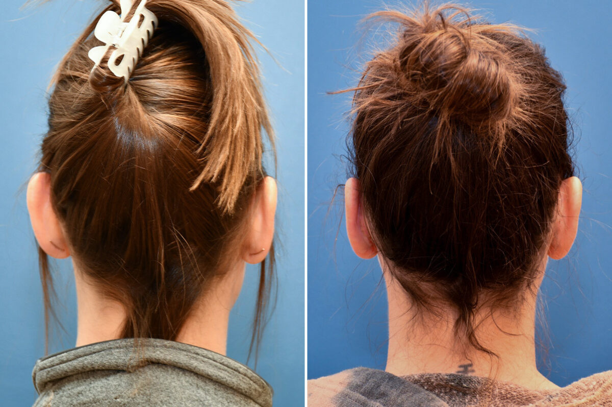 Otoplasty Before and After Photos in Philadelphia, PA, Patient 12310