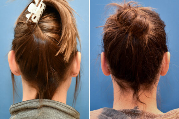 Otoplasty Before and After Photos in Philadelphia, PA, Patient 12310