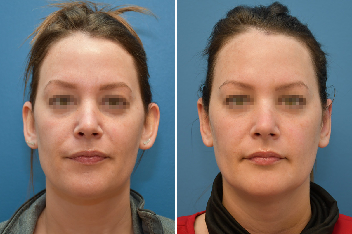 patient-12310-otoplasty-before-after