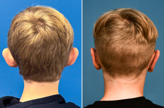 Otoplasty Before and After Photos in Philadelphia, PA, Patient 12317