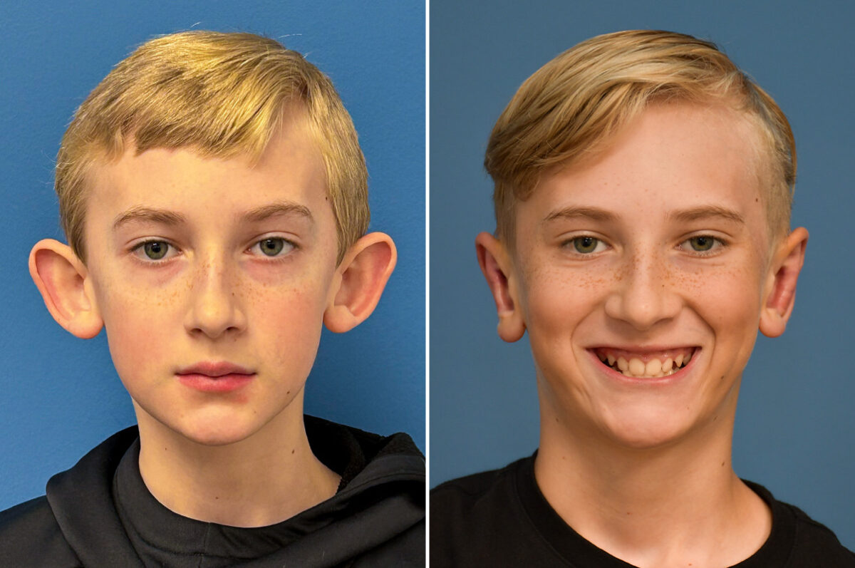 Otoplasty Before and After Photos in Philadelphia, PA, Patient 12317