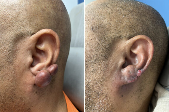 Keloid Removal Before and After Photos in Philadelphia, PA, Patient 12324