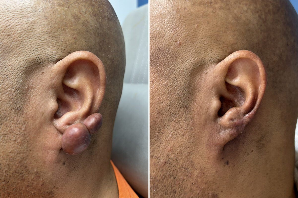 Keloid Removal Before and After Photos in Philadelphia, PA, Patient 12324