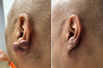 Keloid Removal Before and After Photos in Philadelphia, PA, Patient 12324