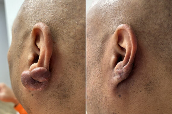 Keloid Removal Before and After Photos in Philadelphia, PA, Patient 12324
