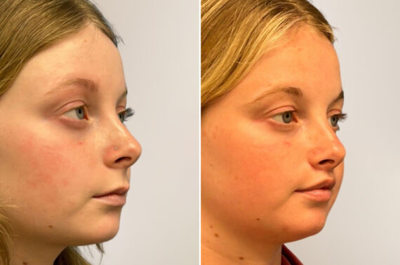 Lip Lift Before and After Photos in Philadelphia, PA, Patient 12335