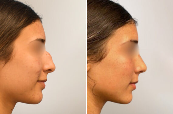 Rhinoplasty Before and After Photos in Philadelphia, PA, Patient 12343