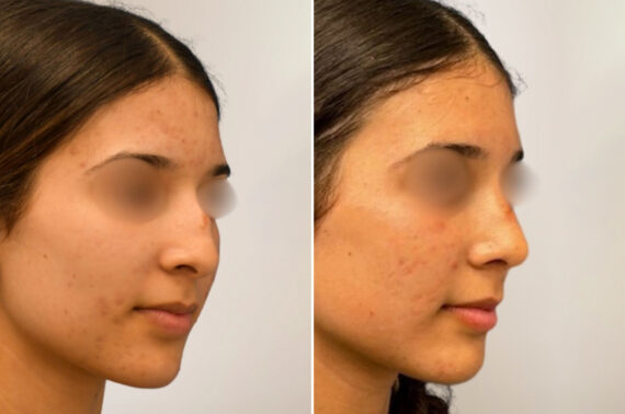 Rhinoplasty Before and After Photos in Philadelphia, PA, Patient 12343