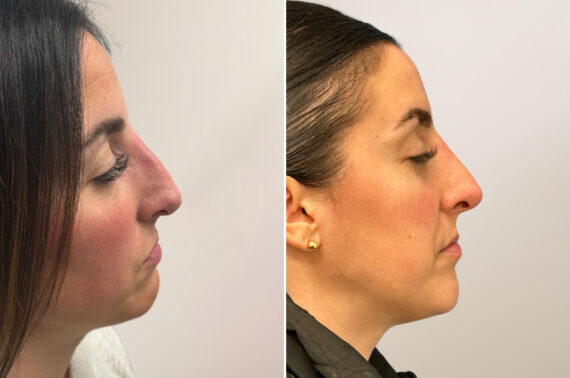 Rhinoplasty Before and After Photos in Philadelphia, PA, Patient 12350