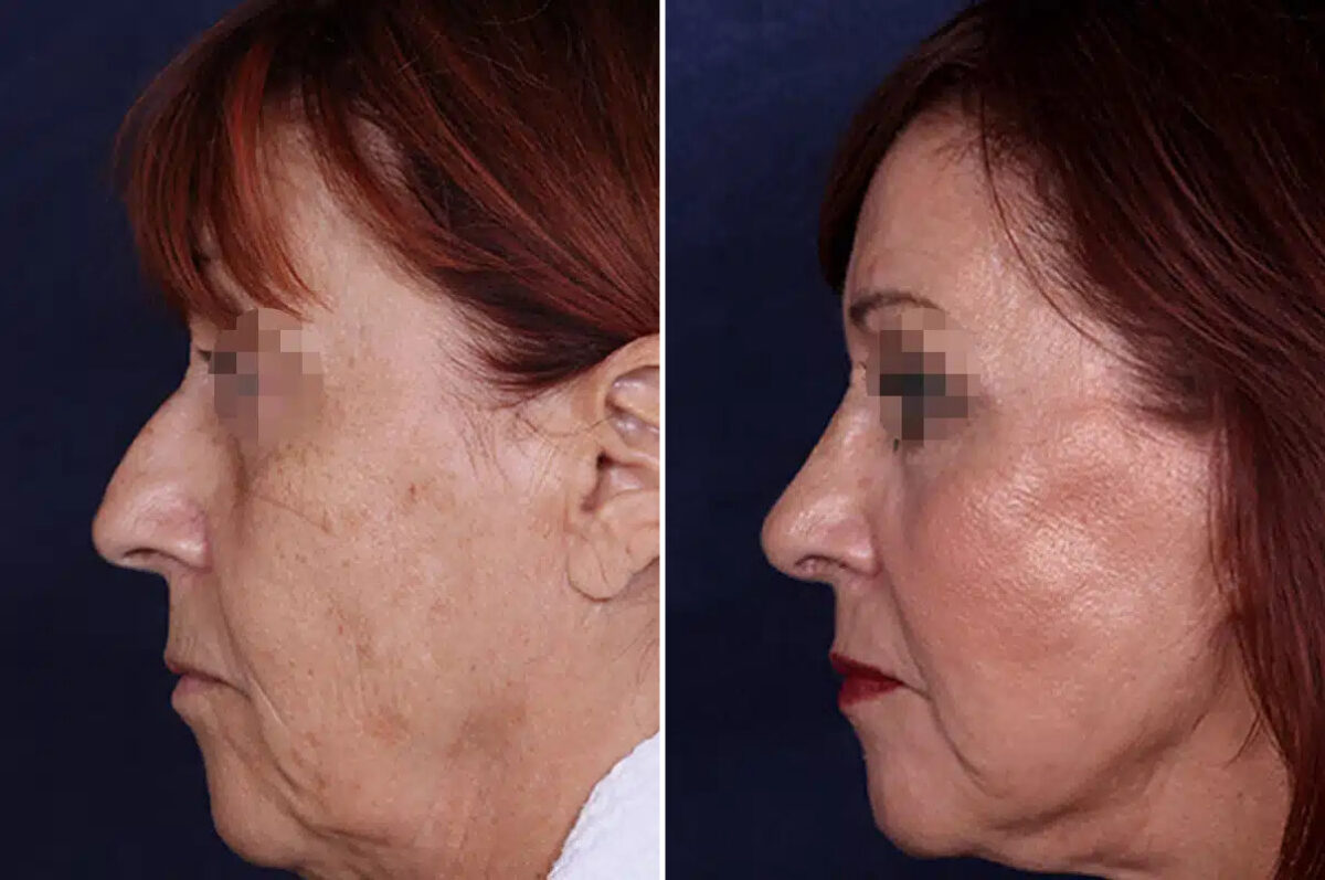 Rhinoplasty Before and After Photos in Philadelphia, PA, Patient 12354