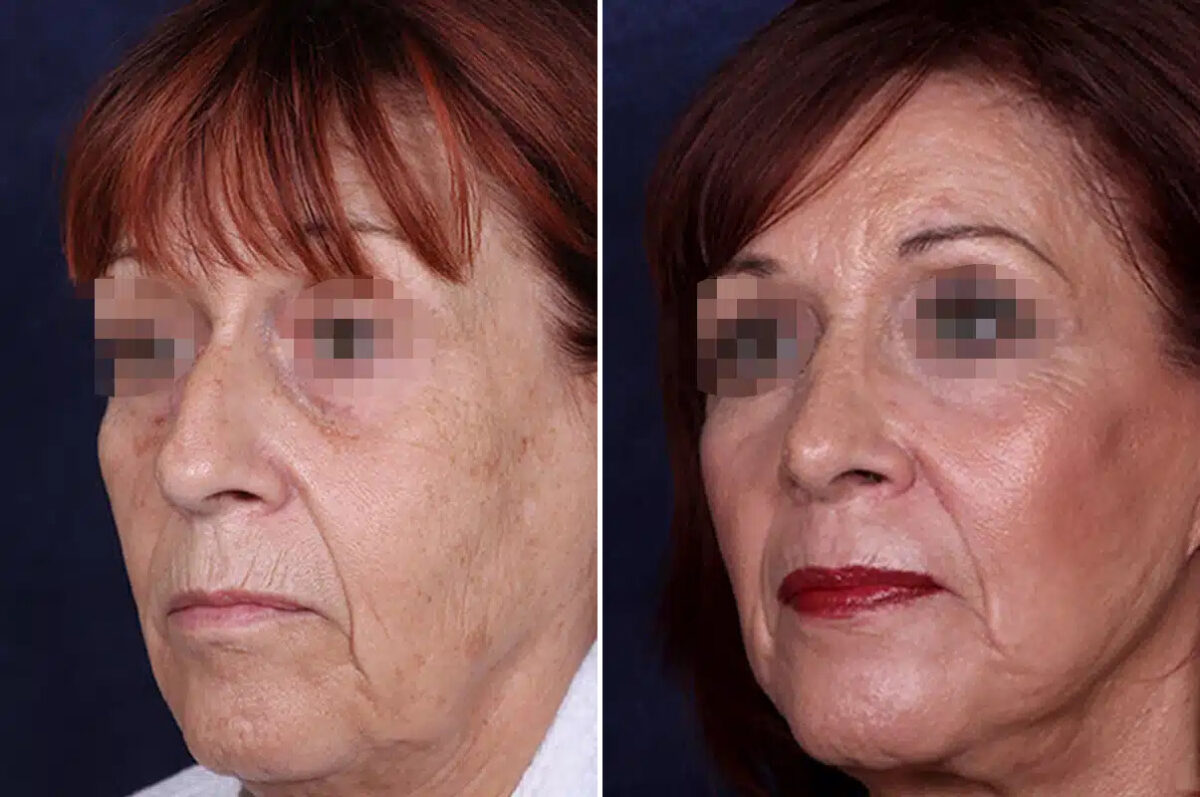 Rhinoplasty Before and After Photos in Philadelphia, PA, Patient 12354